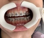 dent-art diş teli