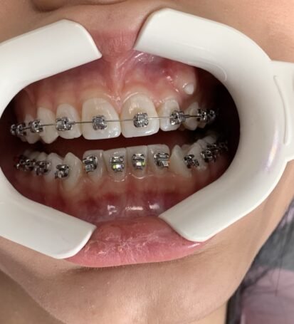dent-art diş teli