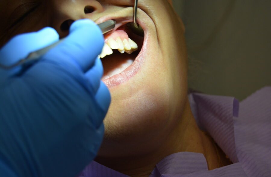 Genel Anestezi Altında Diş Çekimi